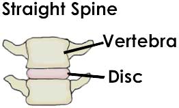 Herniated Disc Basics 1